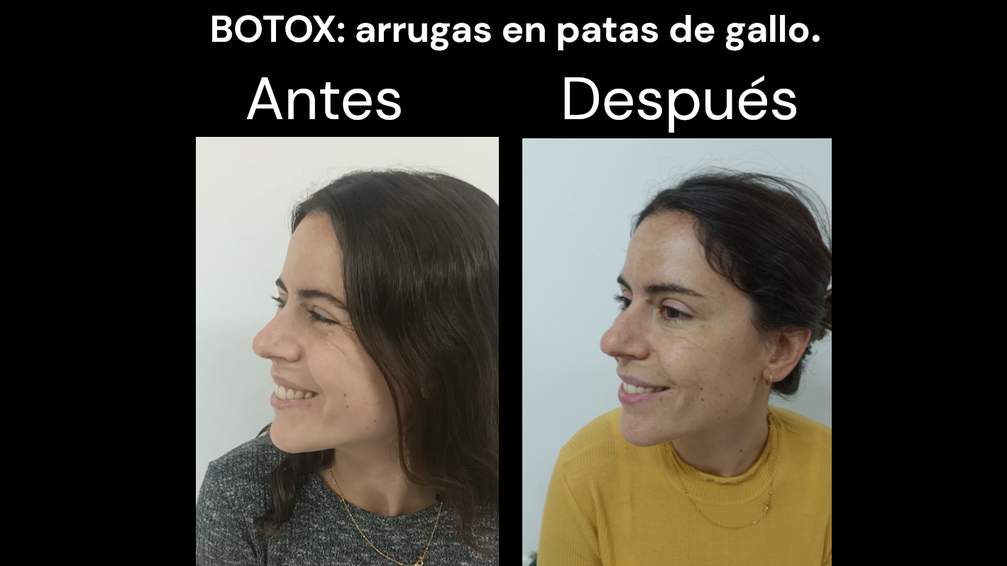 Botox antes y despues