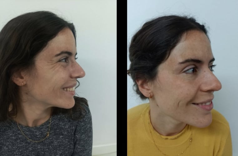 Botox antes y despues