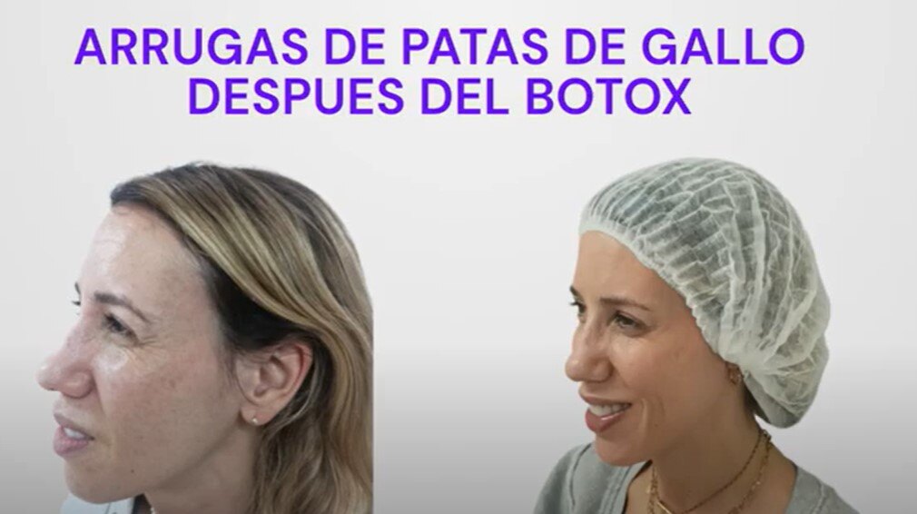 Botox antes y despues en cara-1