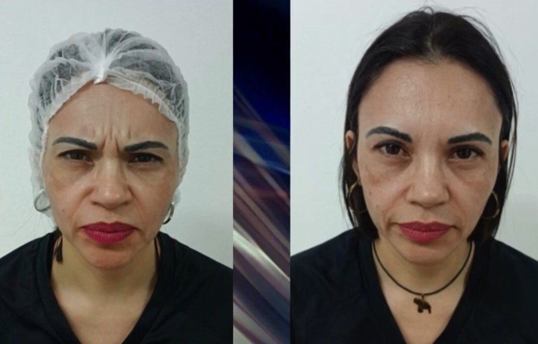 Botox en entrecejo