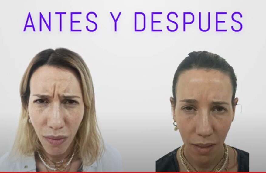 Botox entrecejo antes y despues