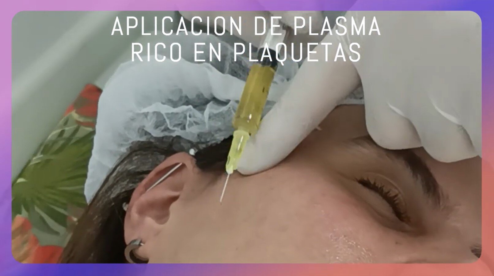 plasma rico en plaquetas facial